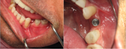 Flap-less and Drill-less dental implant procedure